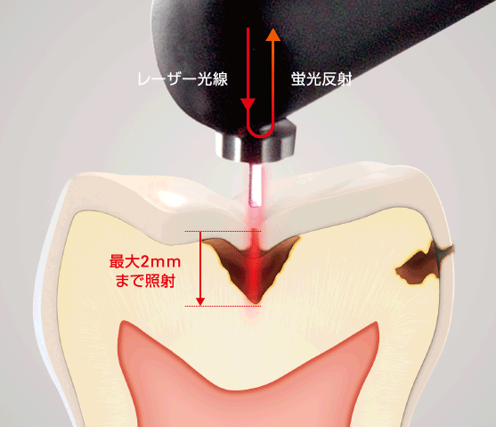 ダイアグノデント・光を歯の表面に当てるだけで痛みはありません